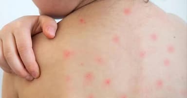 কক্সবাজারে হামে জমজ কন্যা হারিয়ে নিঃস্ব মা