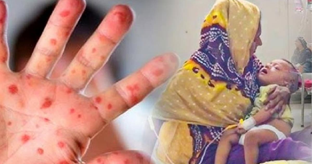 হামের উপসর্গে আরও ৪ জনের মৃত্যু, আক্রান্ত ৭৮৭