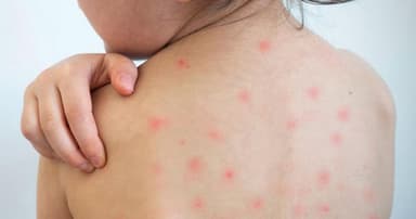 ২৪ ঘণ্টায় হামে সন্দেহজনক মৃত্যু ৬, আক্রান্ত ১১৮৭