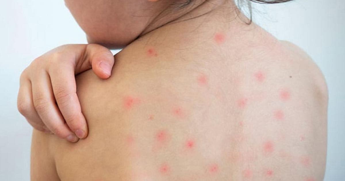 ২৪ ঘণ্টায় হামে সন্দেহজনক মৃত্যু ৬, আক্রান্ত ১১৮৭