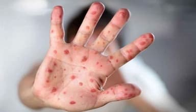 ২৪ ঘণ্টায় শেবাচিমে ১ জনের মৃত্যু, নতুন ভর্তি ৯২