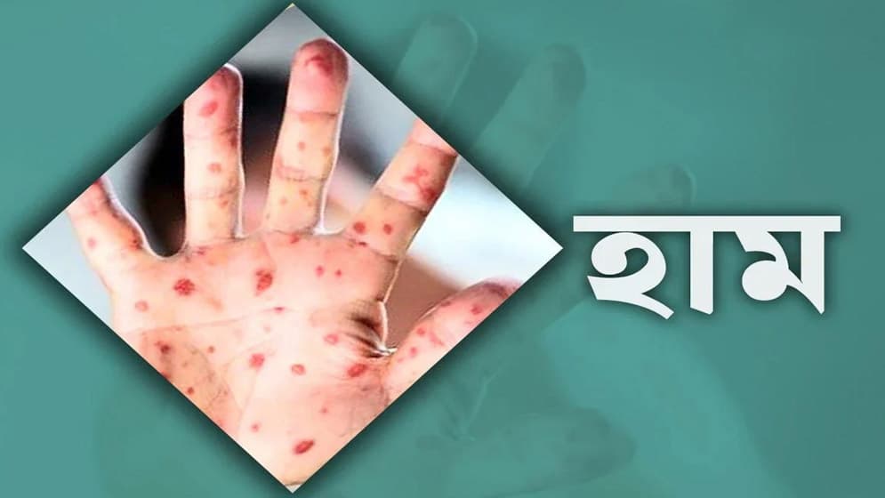 হামে মৃত্যু আরো ৭, আক্রান্ত ১২১৫