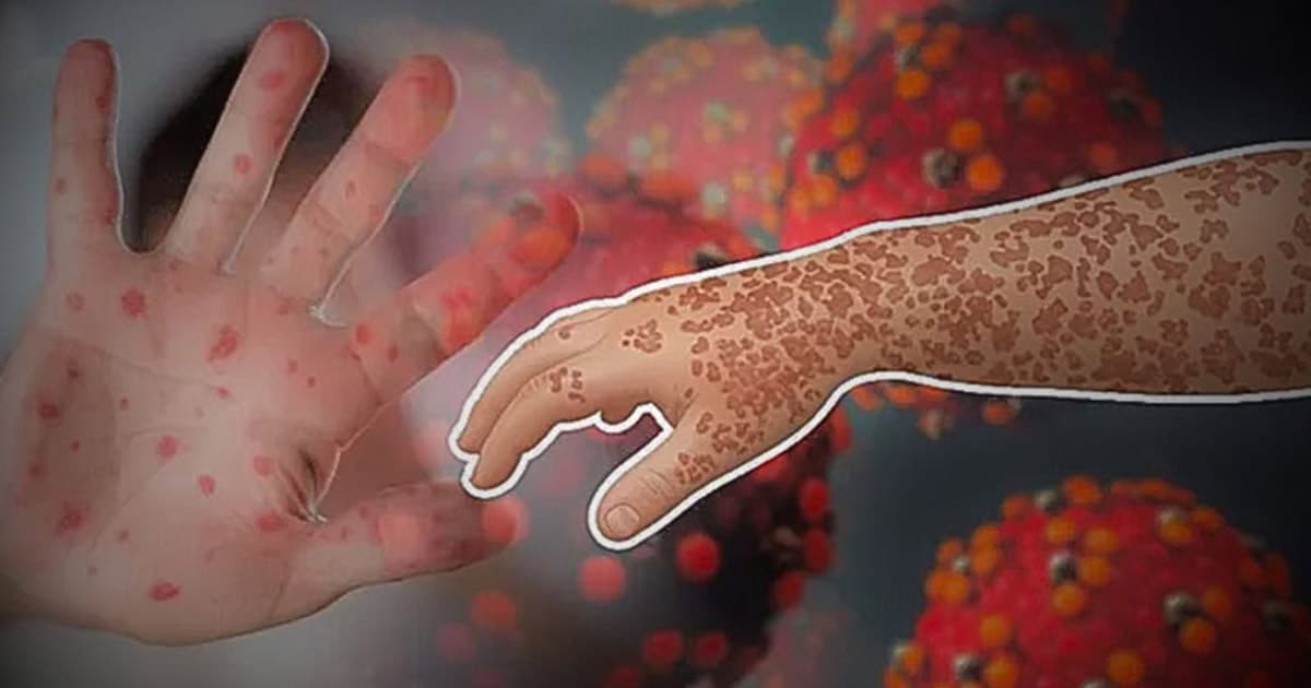 হামের উপসর্গ নিয়ে আরও ১০ শিশুর মৃত্যু