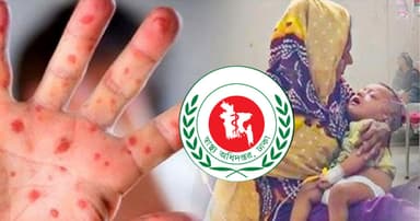 ২৪ ঘণ্টায় হাম ও হামের উপসর্গে আরও ৮ শিশুর মৃত্যু