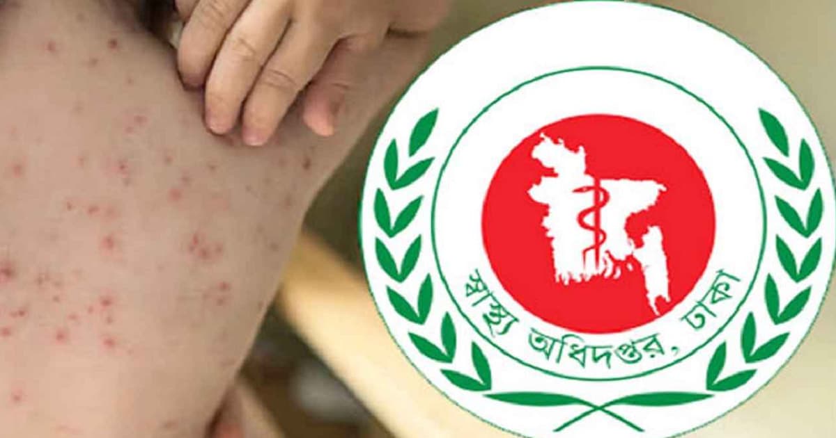 হামে আক্রান্ত ও উপসর্গে আরও মৃত্যু ১০