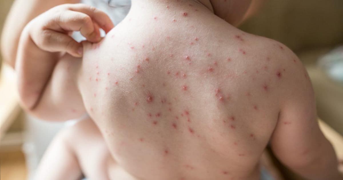 সিলেটে হাম সন্দেহভাজন আরও এক শিশুর মৃত্যু