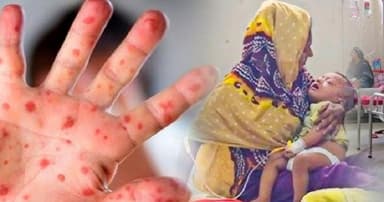 সিলেটে হাম সন্দেহে আরও ৩ শিশুর মৃত্যু