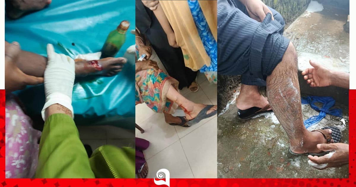 শরীয়তপুরে কুকুরের কামড়ে নারী-শিশুসহ আহত ১০