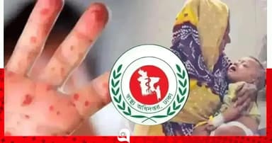 হাম ও উপসর্গে আরও ৭ শিশুর মৃত্যু