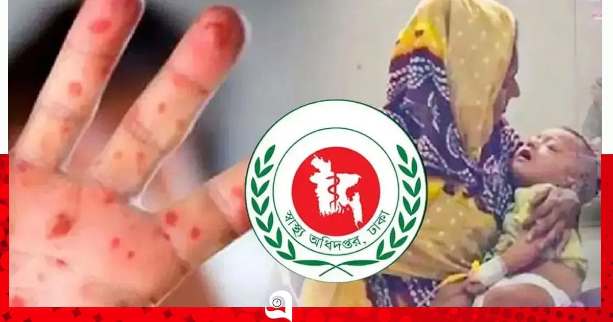হাম ও উপসর্গে আরও ৩ শিশুর মৃত্যু