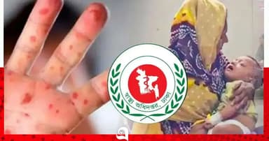 হাম ও উপসর্গে আরও ৩ শিশুর মৃত্যু
