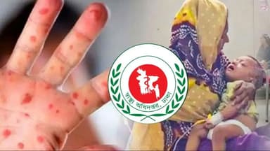 হামের উপসর্গে আরও ৫ শিশুর মৃত্যু
