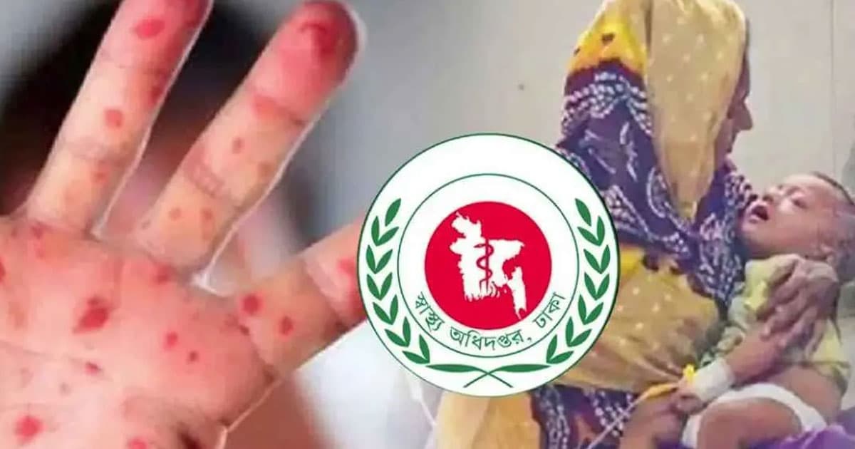 হামের উপসর্গে আরও দুই শিশুর মৃত্যু
