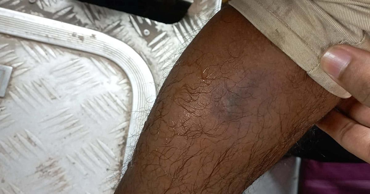 বাসের চাকা বিস্ফোরণে কুবি শিক্ষার্থী আহত
