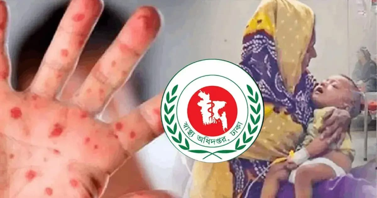 হাম উপসর্গে একদিনে ৩ শিশুর মৃত্যু