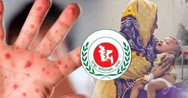 হাম ও উপসর্গে আরও তিন শিশুর মৃত্যু