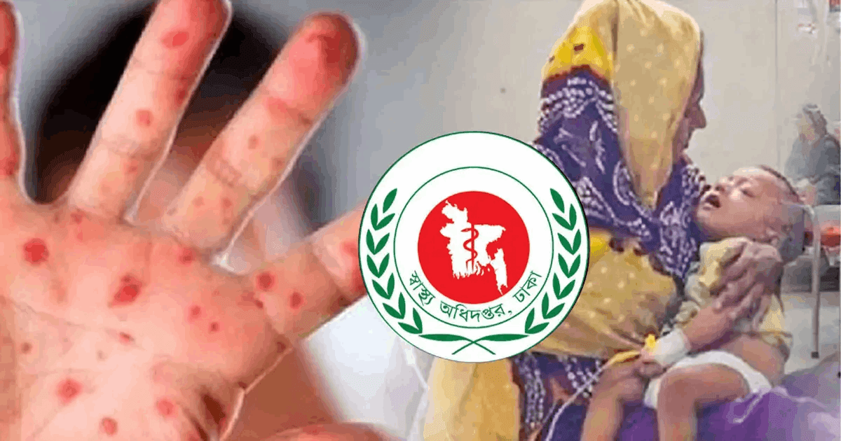 হাম ও উপসর্গে আরও তিন শিশুর মৃত্যু