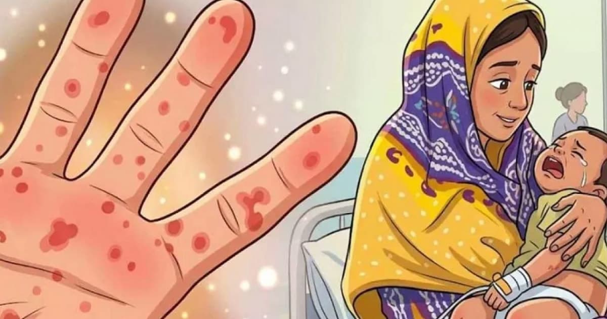 হাম ও উপসর্গে আরও ৭ শিশুর মৃত্যু