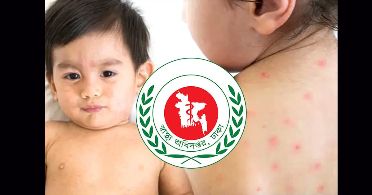 হাম উপসর্গে ২ শিশুর মৃত্যু, আক্রান্ত ৮৬৬