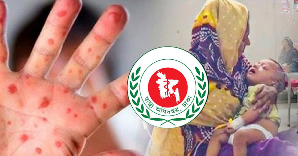 হাম উপসর্গে ৪ শিশুর মৃত্যু, আক্রান্ত ৯৪১