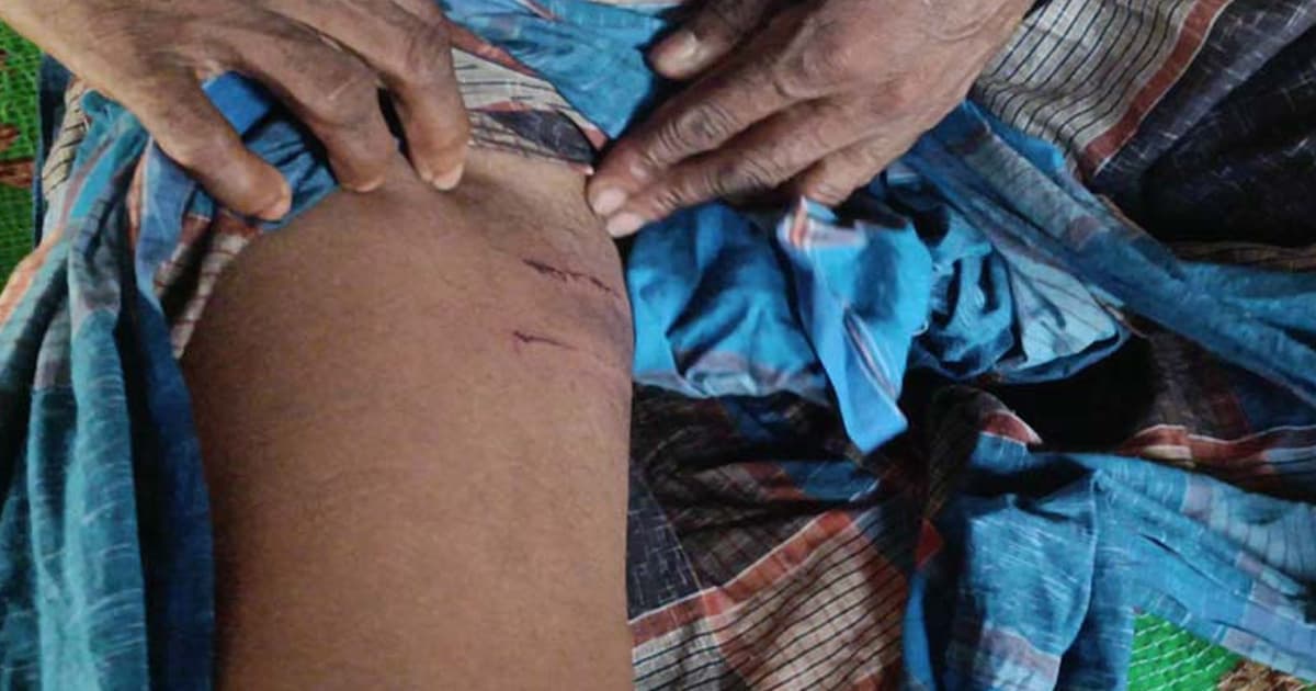 শিবচরে পাগলা কুকুরের তাণ্ডব, শিশুসহ আহত ১০