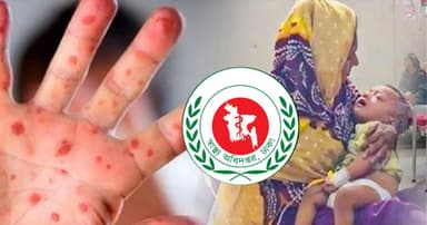 হাম ও উপসর্গে মৃত্যু ৭, আক্রান্ত ১২১২