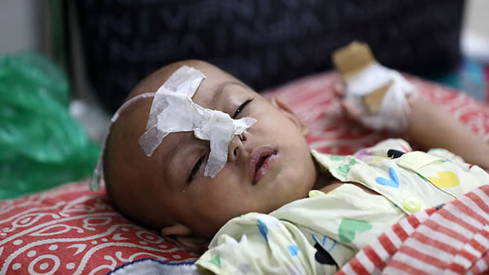 হাম ও হামের উপসর্গে মারা গেল আরও ১০ শিশু