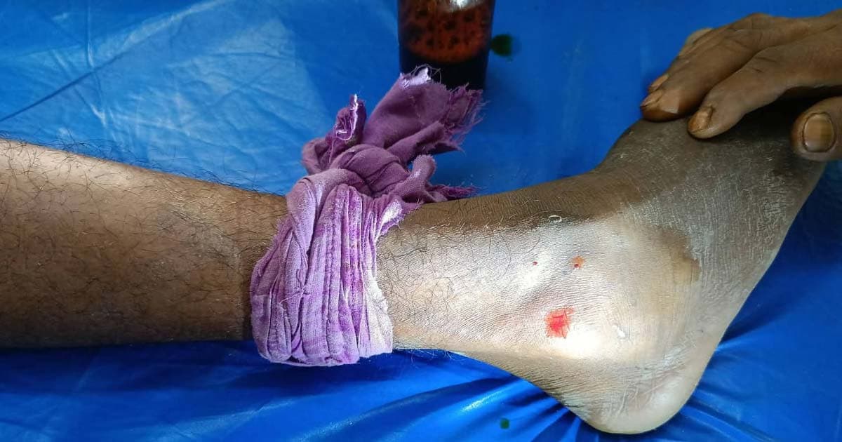 পাটগ্রামে সাপের কামড়ে শিশুর মৃত্যু, আহত ২