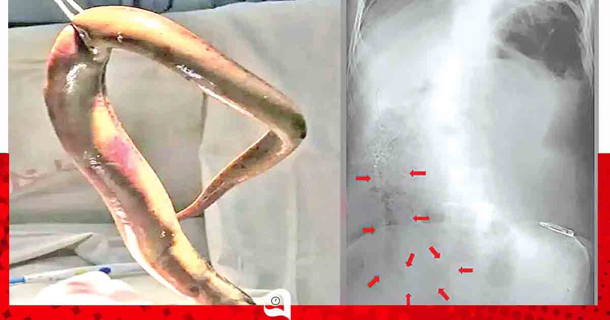বাংলাদেশির শরীরে জীবন্ত প্রাণী!