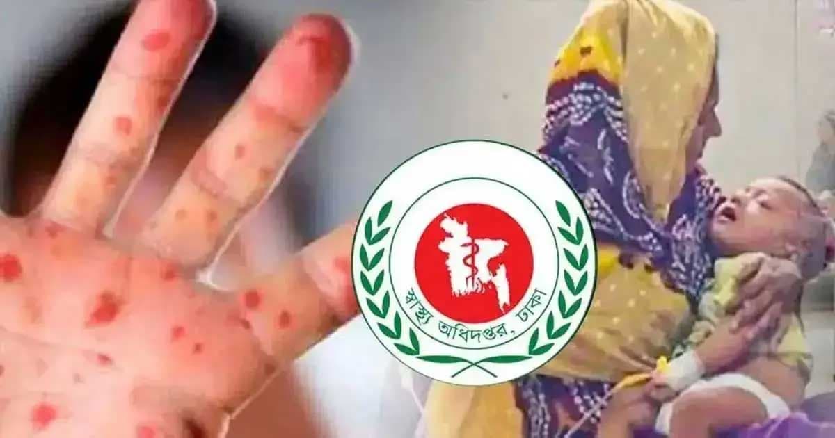 হাম উপসর্গে আরও ৫ জনের মৃত্যু