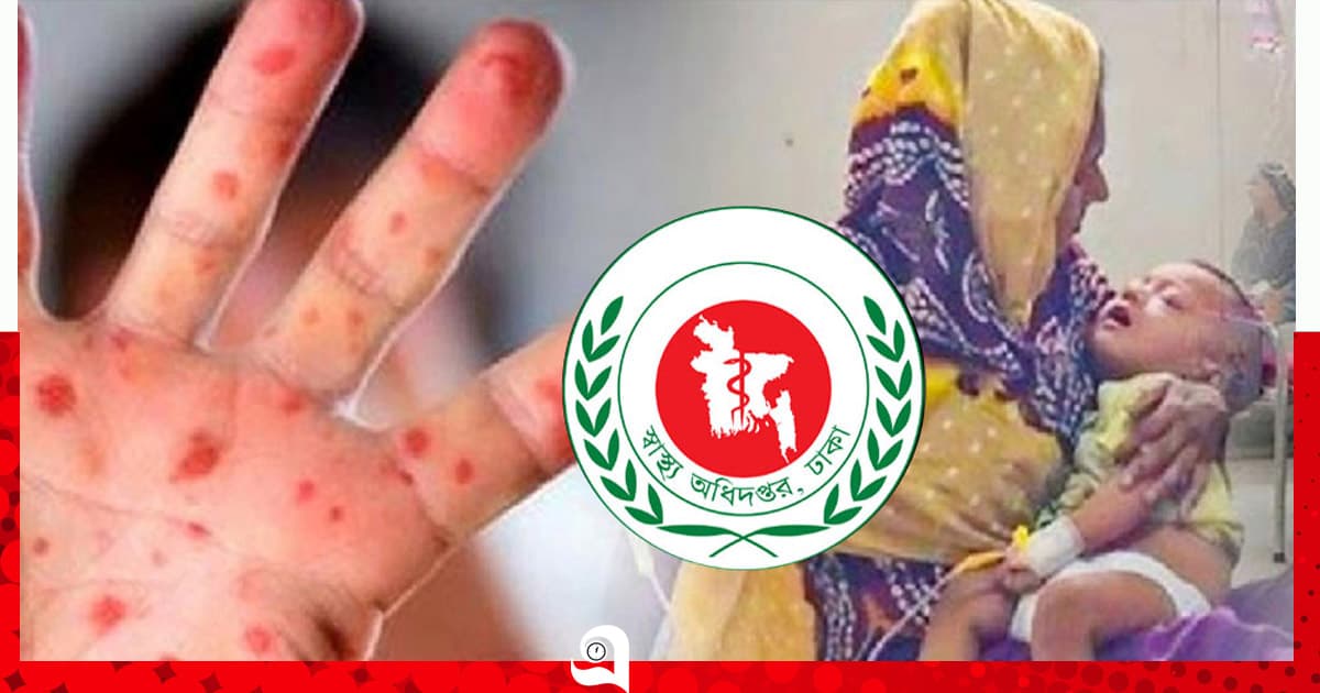হাম ও উপসর্গে মৃত্যু ছাড়াল ১২০০
