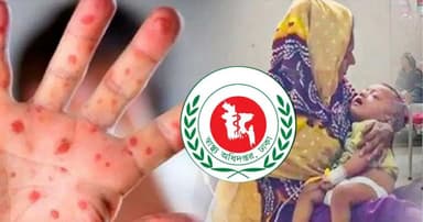 হাম উপসর্গে আরও মৃত্যু ১