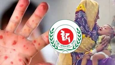 হাম উপসর্গে আরও মৃত্যু ২