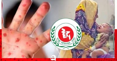 হাম উপসর্গে আরও ৬ শিশুর মৃত্যু, আক্রান্ত ১৩১৬