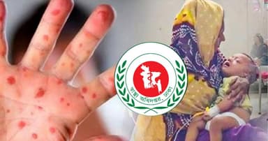 হাম উপসর্গে আরও ৬ শিশুর মৃত্যু, আক্রান্ত ১২৩১