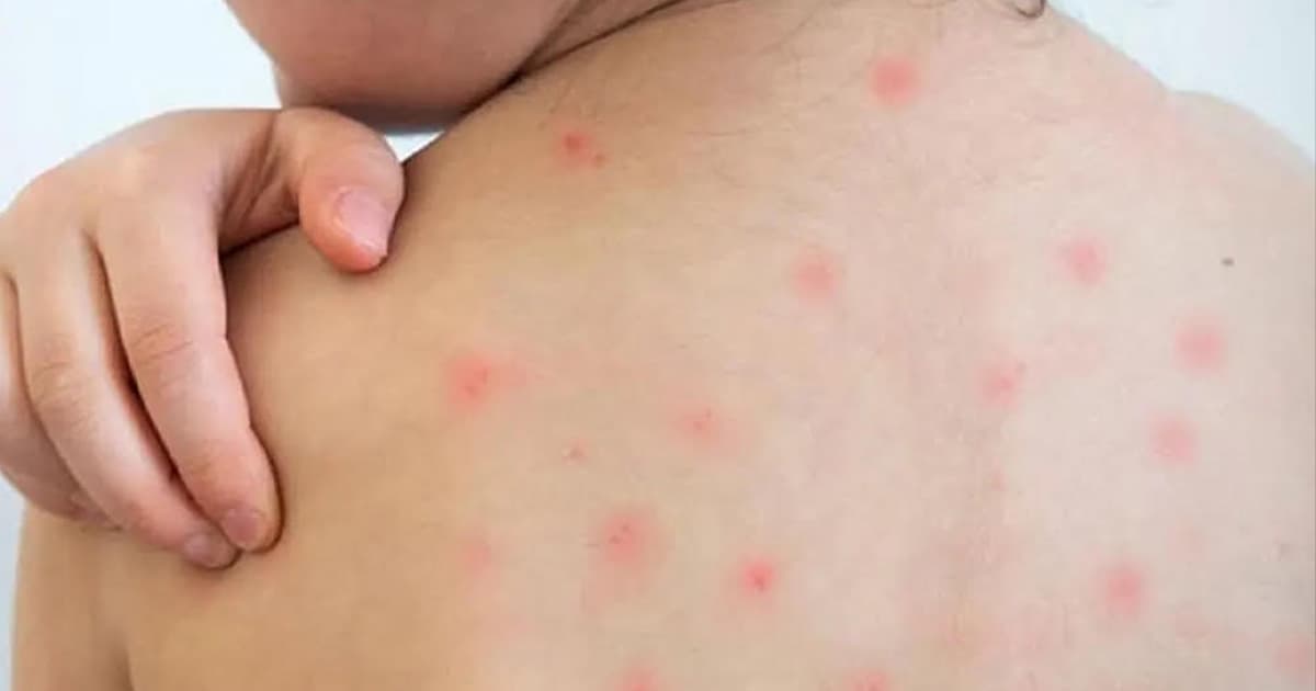 কক্সবাজারে হামে জমজ কন্যা হারিয়ে নিঃস্ব মা