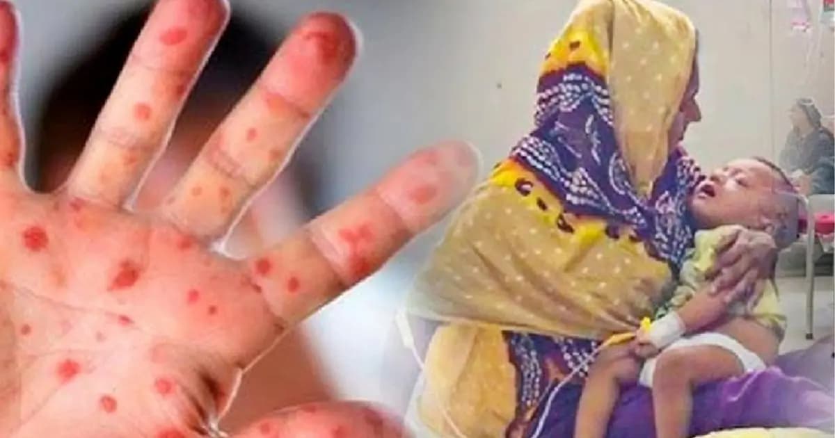 আজ হামের জরুরি টিকার তালিকায় কোন কোন উপজেলা