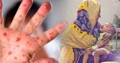 হামের উপসর্গে আরও ৪ জনের মৃত্যু, আক্রান্ত ৭৮৭