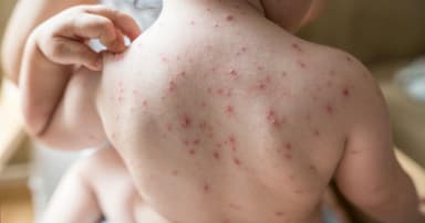 সিলেটে হাম সন্দেহভাজন আরও এক শিশুর মৃত্যু