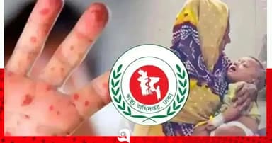 হাম ও উপসর্গে আরও ৫ শিশুর মৃত্যু