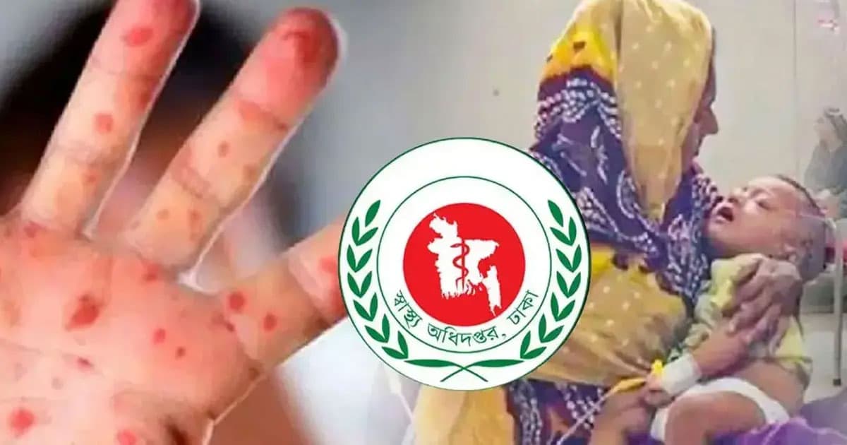 হাম ও উপসর্গে ৬ শিশুর মৃত্যু