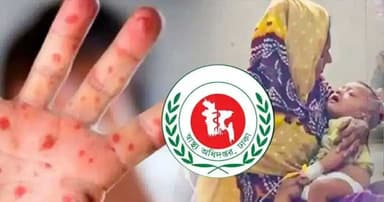 হাম উপসর্গে আরও ৫ জনের মৃত্যু